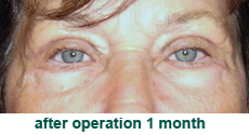 plastic-surgery-blepharoplasty